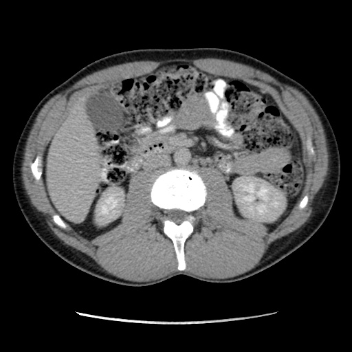 File:Appendicitis complicated by post-operative collection (Radiopaedia 35595-37113 A 31).jpg