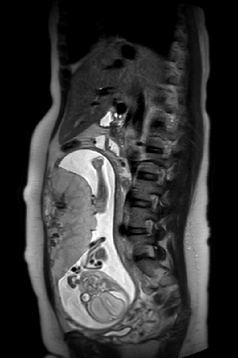 Appendicitis in gravida (MRI) (Radiopaedia 89433-106395 Sagittal T2 37).jpg