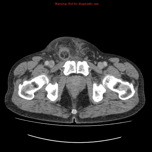 File:Appendicitis mass in inguinal hernia (Radiopaedia 26858-27029 A 31).jpg
