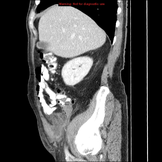File:Appendicitis mass in inguinal hernia (Radiopaedia 26858-27029 C 12).jpg