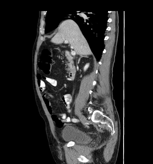 File:Appendicitis with localized perforation and abscess formation (Radiopaedia 49035-54130 C 25).jpg