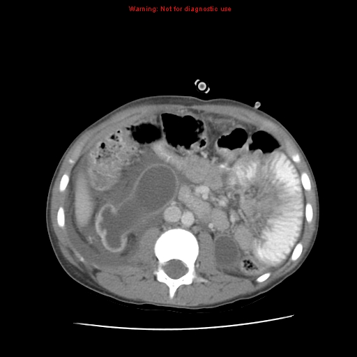 File:Appendicitis with phlegmon (Radiopaedia 9358-10046 A 34).jpg