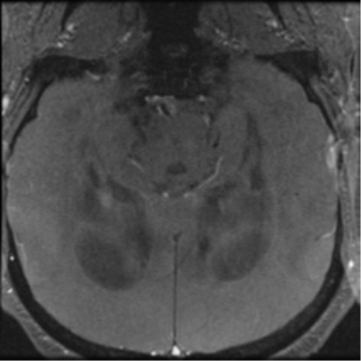 Aqueduct stenosis with corpus callosum hypoattenuation post shunting (Radiopaedia 37212-38969 Axial CSF Flow 60).png
