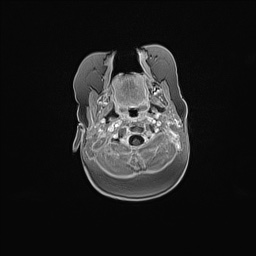 Aqueductal stenosis (Radiopaedia 73974-84802 Axial T1 C+ 28).jpg