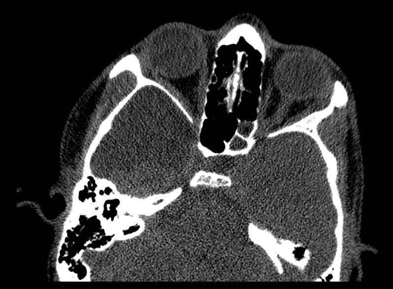 Arachnoid cyst- extremely large (Radiopaedia 68741-78450 Axial bone window 22).jpg