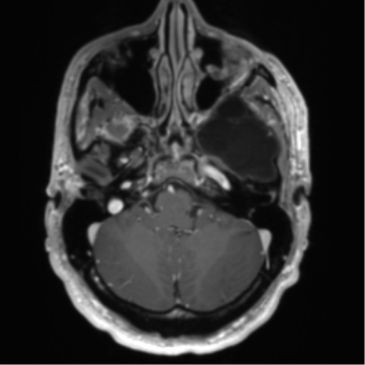 File:Arachnoid cyst with subdural hematoma (Radiopaedia 85892-101743 Axial T1 C+ 21).png