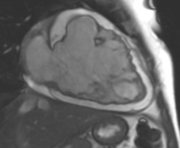 Arrhythmogenic right ventricular cardiomyopathy (Radiopaedia 69431-79307 2ch cine 79).jpg