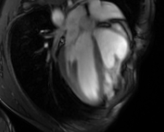 Arrhythmogenic right ventricular cardiomyopathy (Radiopaedia 69564-79464 4ch cine 44).jpg
