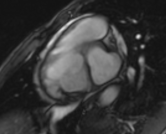 Arrhythmogenic right ventricular cardiomyopathy (Radiopaedia 69564-79464 short axis cine 226).jpg