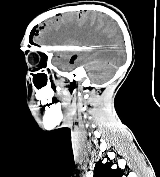 Arrow injury to the brain (Radiopaedia 72101-82607 H 43).jpg