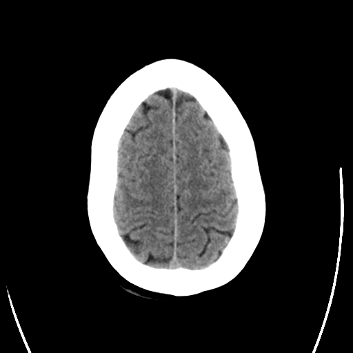 File:Arteriovenous malformation (cerebral) (Radiopaedia 40070-42579 Axial non-contrast 27).png