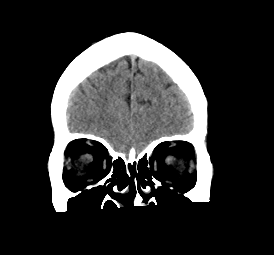 File:Arteriovenous malformation (cerebral) (Radiopaedia 40070-42579 Coronal non-contrast 8).png