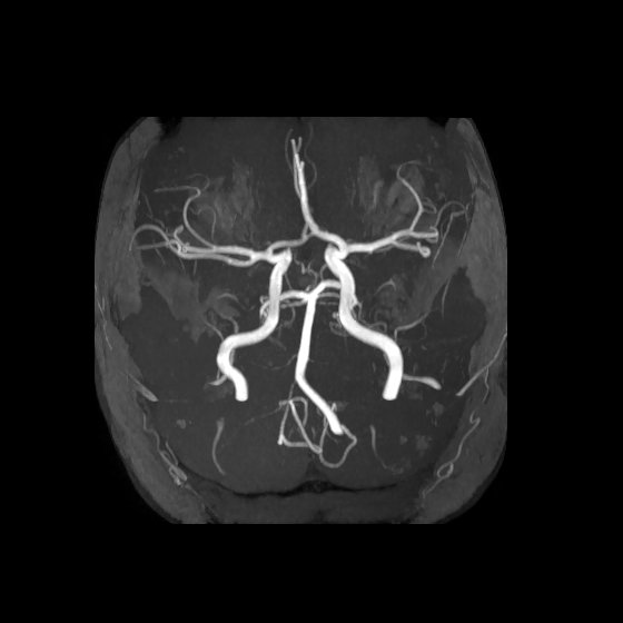 File:Artery of Percheron infarct (Radiopaedia 40966-43676 MRA 1).jpg