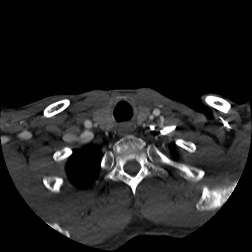 Artery of Percheron infarct (Radiopaedia 48088-52894 A 33).jpg