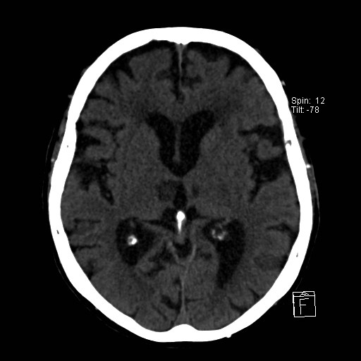 File:Artery of Percheron infarction (Radiopaedia 26307-26439 Axial non-contrast 18).jpg