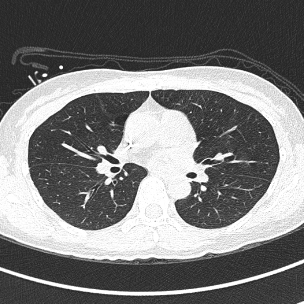Aspergilloma (Radiopaedia 26223-26347 Axial lung window 39).jpg