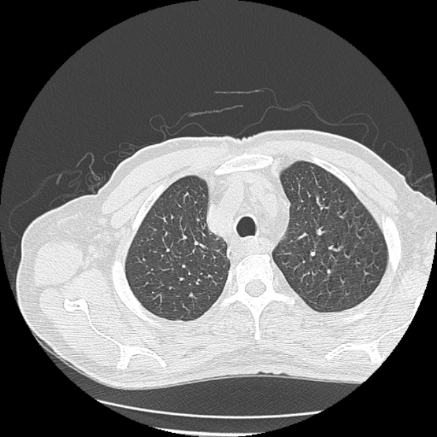 Aspergilloma (Radiopaedia 44592-48327 Axial lung window 13).jpg