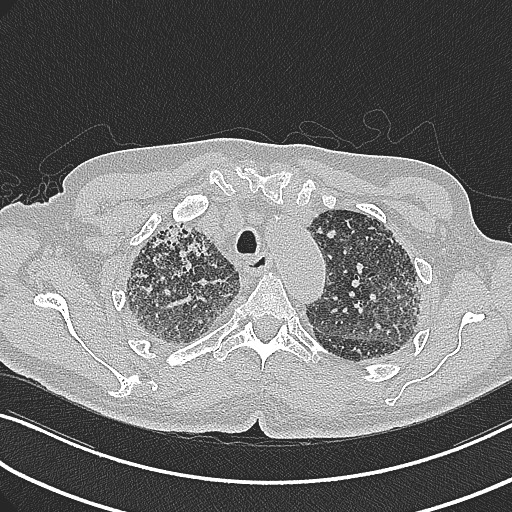 File:Aspergilloma on background pulmonary fibrosis (Radiopaedia 60942-68757 B 14).jpg