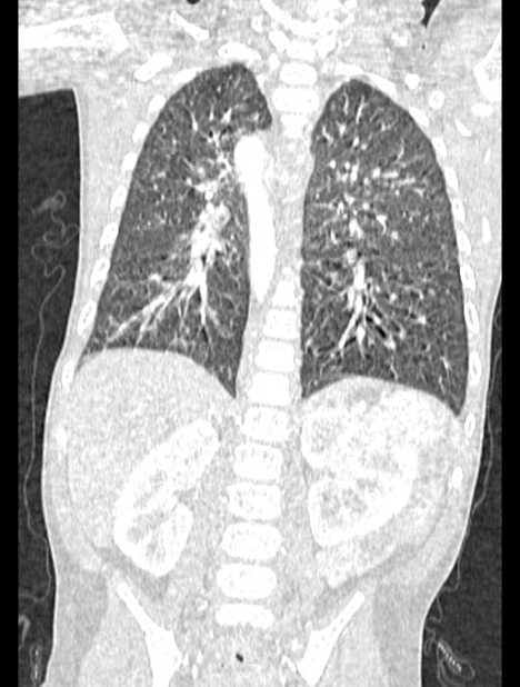 Asplenia syndrome (Radiopaedia 73083-83792 Coronal lung window 96).jpg