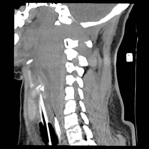 File:Atlanto-occipital dislocation (Radiopaedia 44648-48412 A 11).jpg