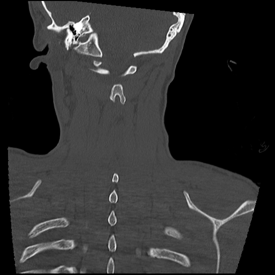 Atlanto-occipital dissociation (Traynelis type 1), C2 teardrop fracture, C6-7 facet joint dislocation (Radiopaedia 87655-104061 Coronal bone window 55).jpg