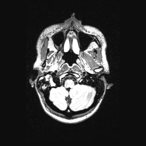 Atretic encephalocoele with inferior vermis hypoplasia (Radiopaedia 30443-31108 Axial 28).jpg