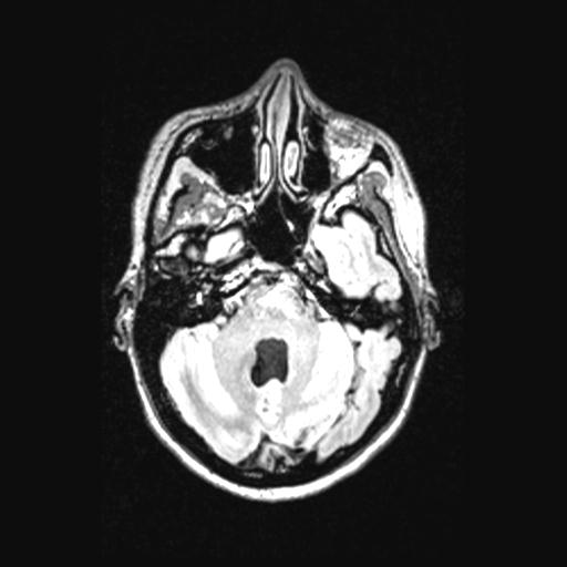 Atretic encephalocoele with inferior vermis hypoplasia (Radiopaedia 30443-31108 Axial 47).jpg