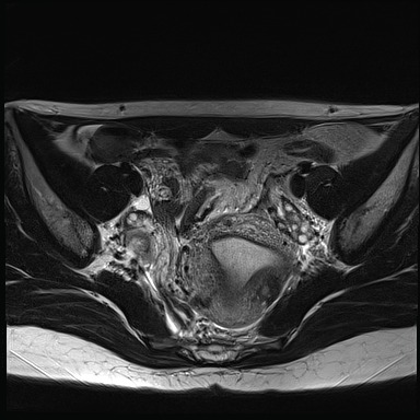 File:Atypical deep infiltrating endometriosis (Radiopaedia 44470-48125 Axial T2 12).jpg