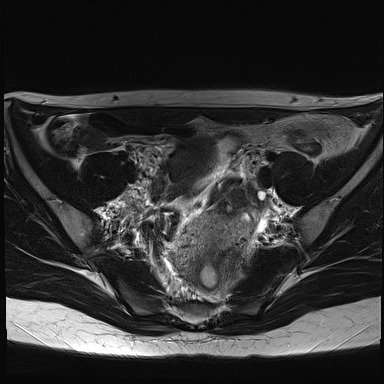 File:Atypical deep infiltrating endometriosis (Radiopaedia 44470-48125 Axial T2 9).jpg