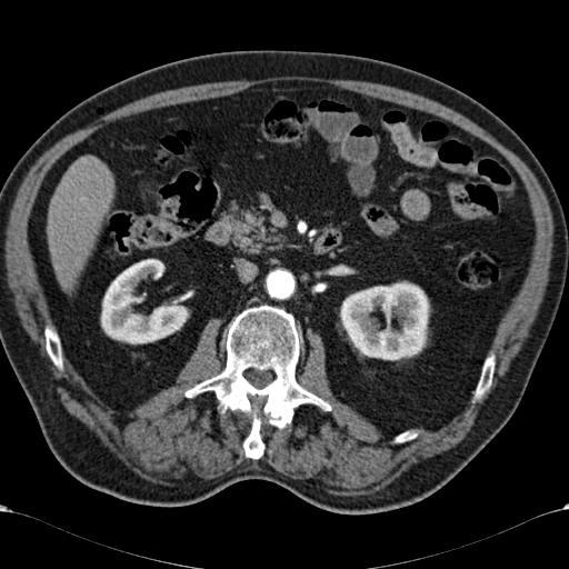 Atypical hepatocellular carcinoma (Radiopaedia 41744-44698 A 47).jpg