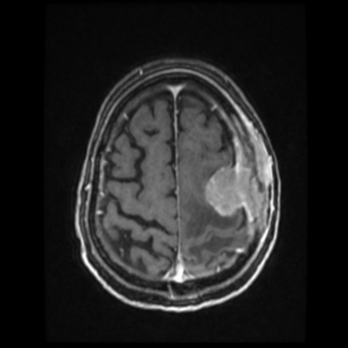 Atypical meningioma (Radiopaedia 45535-49629 Axial T1 C+ 55).jpg
