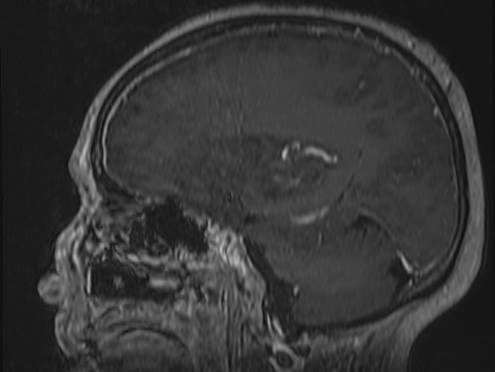 Atypical meningioma (Radiopaedia 62985-71406 Sagittal T1 C+ 56).jpg