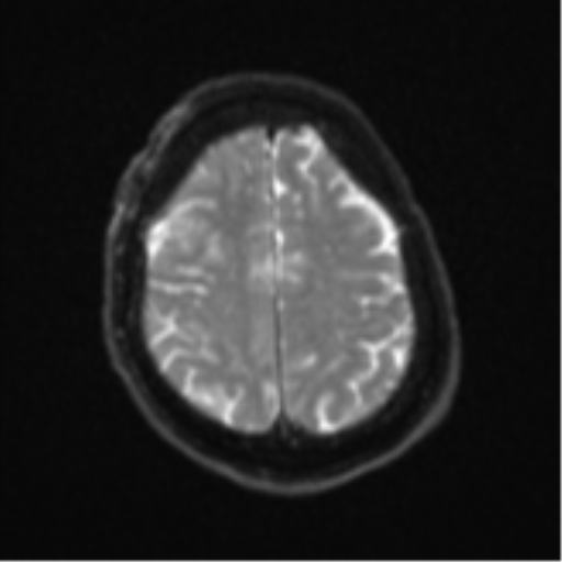 Atypical meningioma (WHO Grade II) (Radiopaedia 54742-60981 Axial DWI 22).png