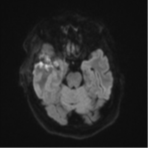 Atypical meningioma (WHO Grade II) (Radiopaedia 54742-60981 Axial DWI 38).png