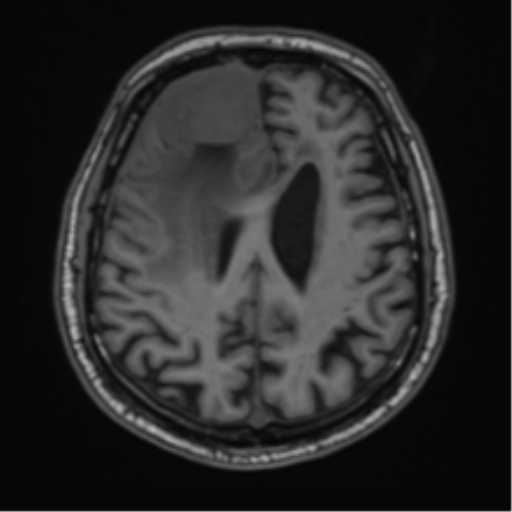 File:Atypical meningioma (WHO grade II) with brain invasion (Radiopaedia 57767-64729 Axial T1 35).png
