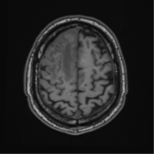 File:Atypical meningioma (WHO grade II) with brain invasion (Radiopaedia 57767-64729 Axial T1 42).png
