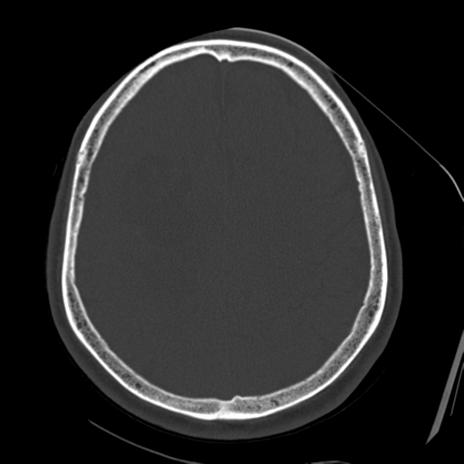 File:Atypical meningioma (WHO grade II) with osseous invasion (Radiopaedia 53654-59715 Axial bone window 57).png