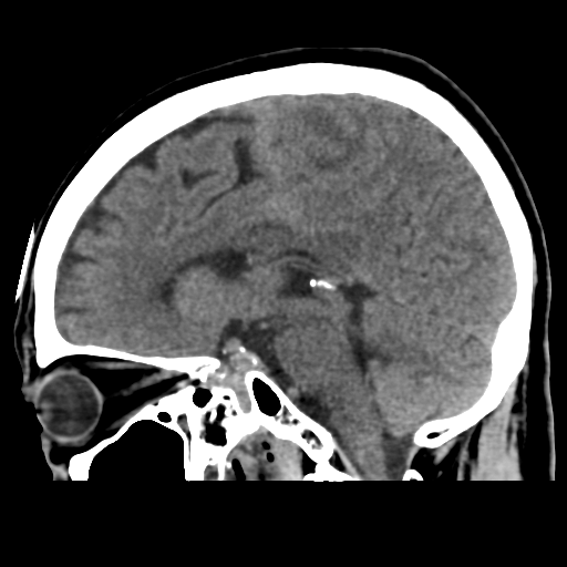 Atypical meningioma (WHO grade II) with osseous invasion (Radiopaedia 53654-59715 C 29).png