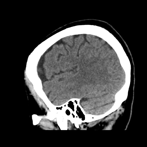Atypical meningioma (WHO grade II) with osseous invasion (Radiopaedia 53654-59715 C 43).png