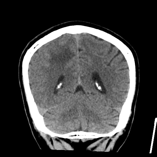 Atypical meningioma (WHO grade II) with osseous invasion (Radiopaedia 53654-59715 Coronal non-contrast 46).png