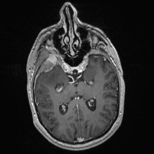 Atypical meningioma (grade II) - en plaque (Radiopaedia 29633-30147 Axial T1 C+ 85).jpg