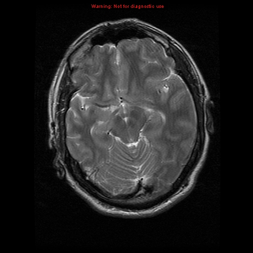 File:Atypical meningioma - grade II (Radiopaedia 13303-13305 Axial T2 9).jpg