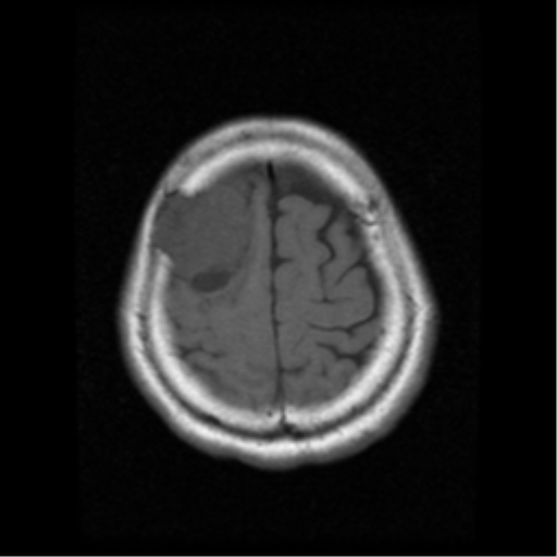 File:Atypical meningioma with skull invasion (Radiopaedia 34357-35648 Axial T1 19).png
