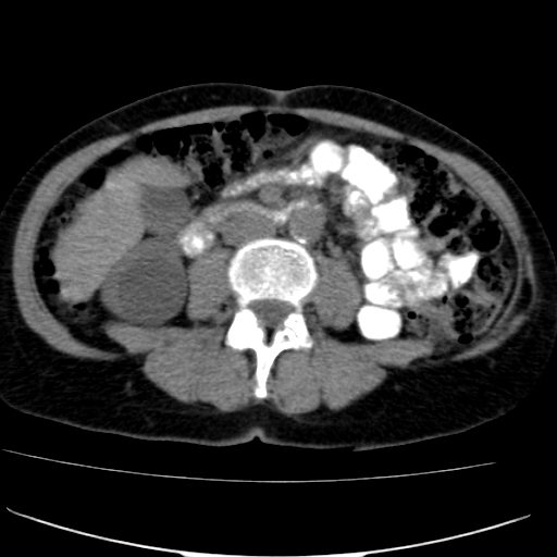 File:Atypical renal cyst (Radiopaedia 17536-17251 non-contrast 24).jpg