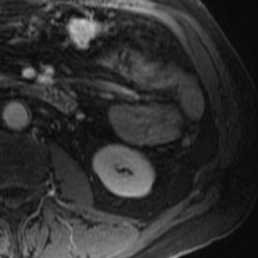 File:Atypical renal cyst on MRI (Radiopaedia 17349-17046 D 26).jpg