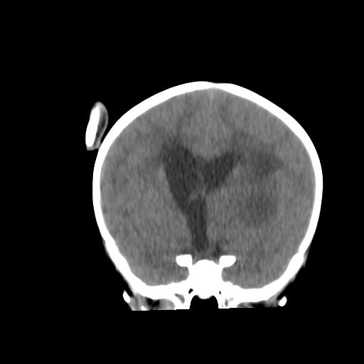 Atypical teratoid rhabdoid tumor (AT-RT) (Radiopaedia 85823-101654 Coronal non-contrast 21).jpg