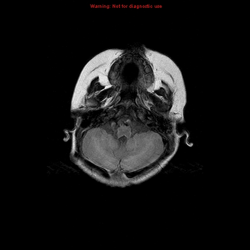 File:Atypical teratoid rhabdoid tumor (Radiopaedia 10712-11183 Axial FLAIR 15).jpg