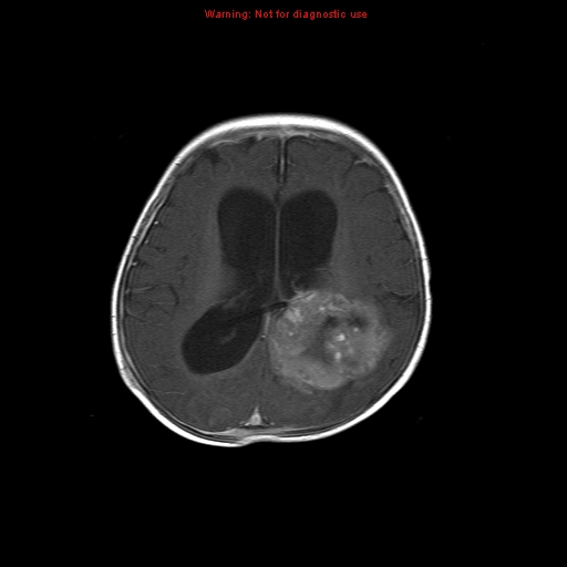 File:Atypical teratoid rhabdoid tumor (Radiopaedia 10712-11183 Axial T1 C+ 7).jpg