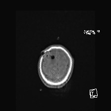 Atypical teratoid rhabdoid tumor (prenatal US and neonatal MRI) (Radiopaedia 59091-66388 Axial T1 51).jpg