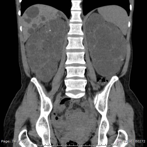 File:Autosomal dominant polycystic kidney disease (Radiopaedia 44122-47684 Coronal 16).jpg